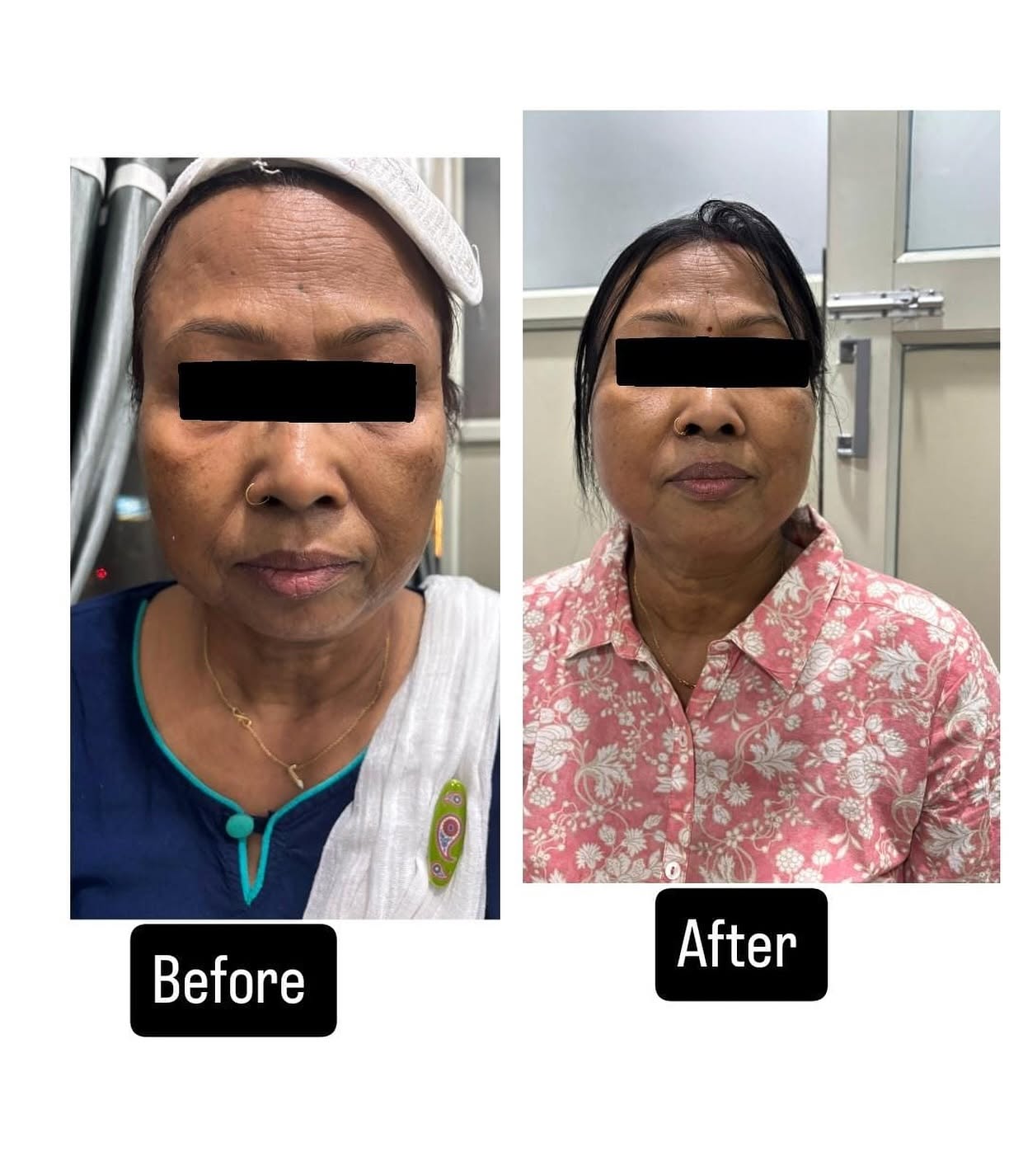 Patient before and after result supplied by Dr. Classy Aesthetics Guwahati